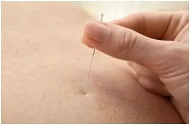 特色针刺疗法：穴位埋线、电针、撳针、耳穴压豆等。