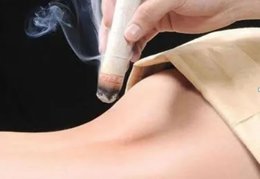 特色艾灸疗法：艾柱灸、隔物灸、火龙灸、督脉灸等。